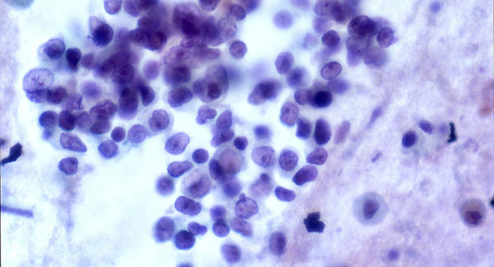 Científicos rusos hacen “explotar” células de cáncer