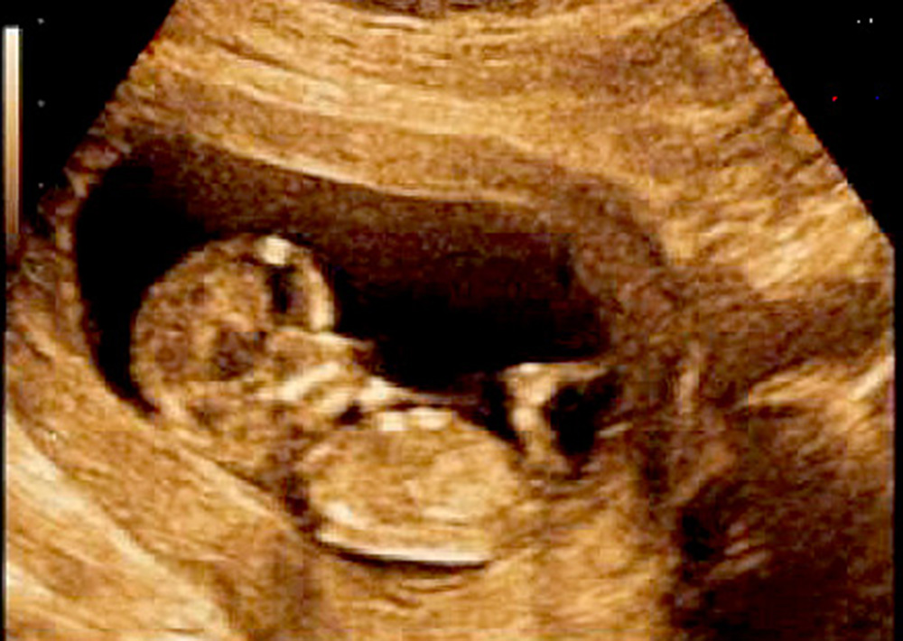 Cuidados prenatales disminuyen riesgo de defectos en bebés