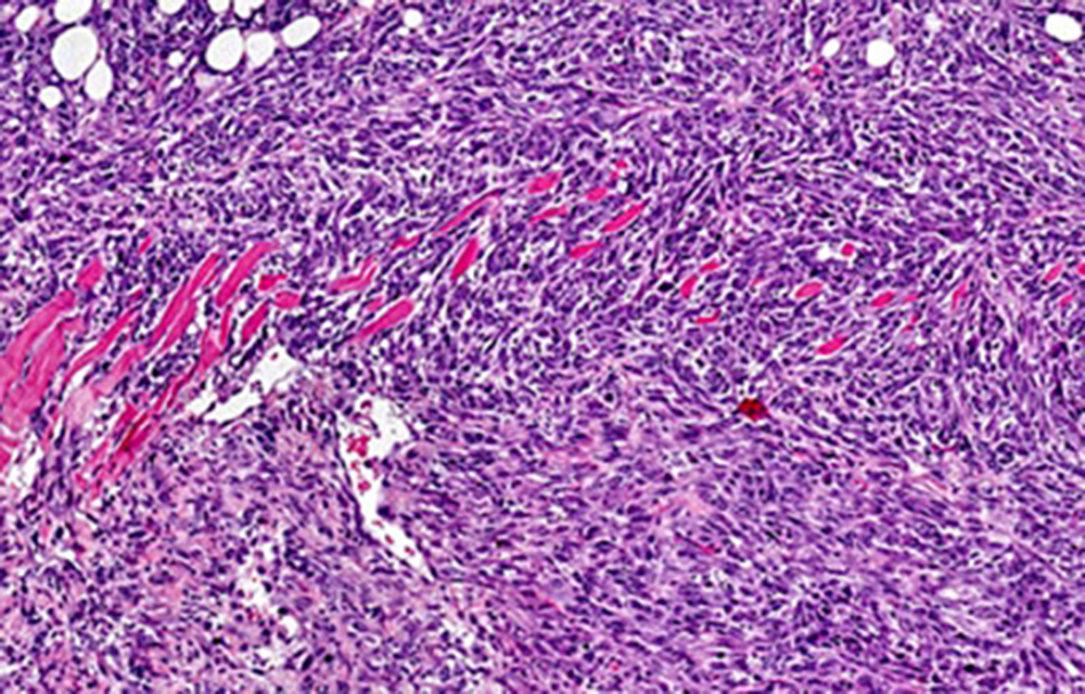 Resultados prometedores de tratamiento contra el cáncer en pacientes con linfoma