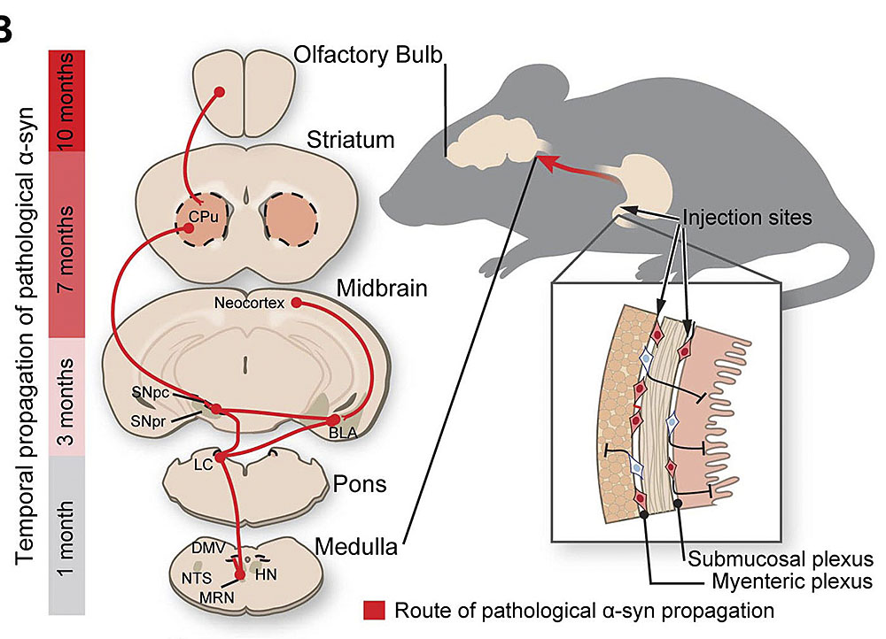 Origen del Parkinson podría estar en el intestino