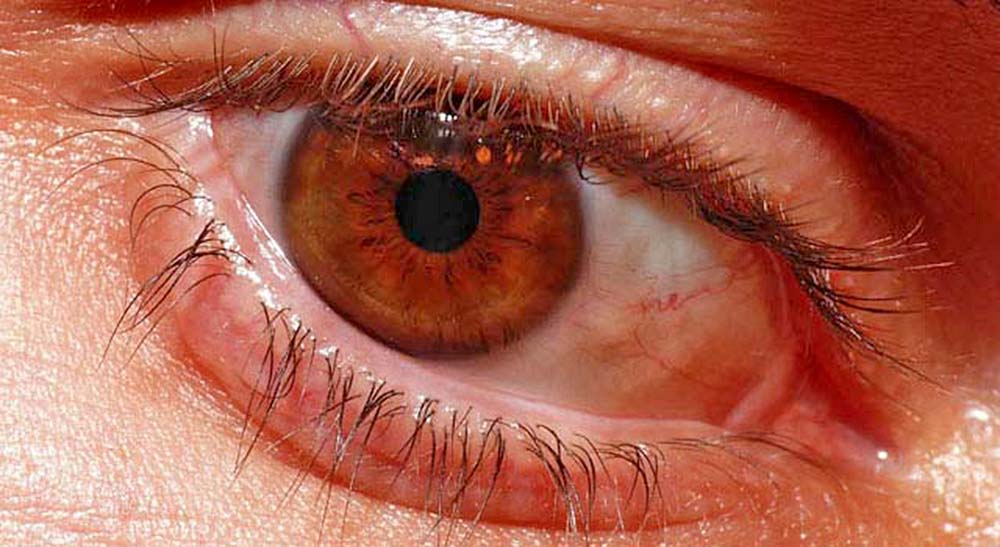 Identifican que grasa de la piel puede disminuir riesgos de retinopatía diabética