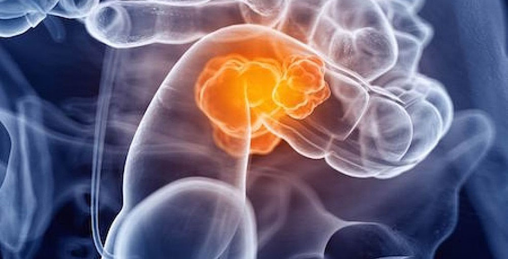 Cáncer colorrectal es cada vez más frecuente en menores de 40 años