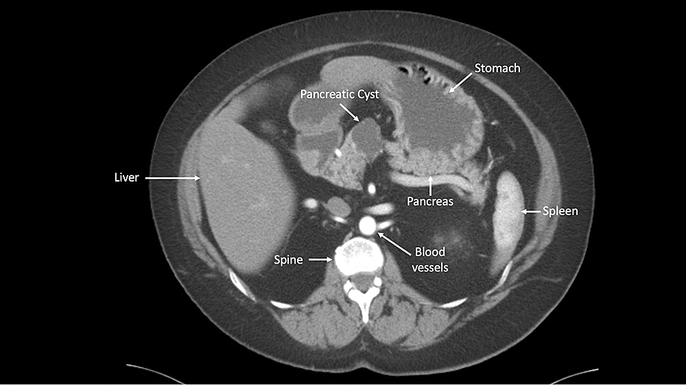 Con inteligencia artificial, prueba identifica con precisión quistes pancreáticos pre-cancerosos