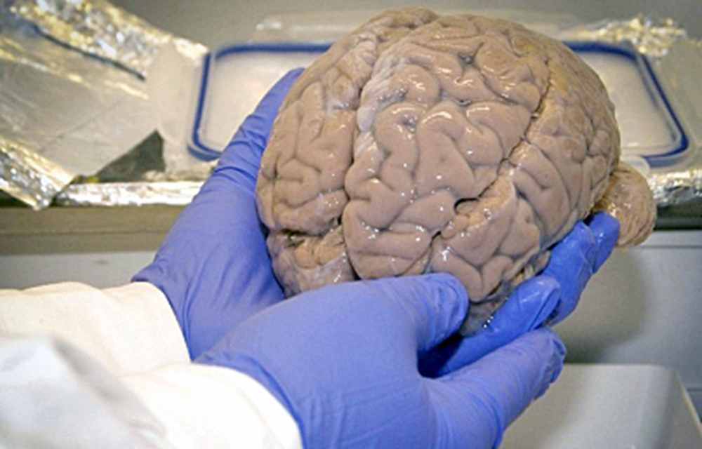 Identifican biomarcador en sangre para tratar Alzheimer en fase temprana