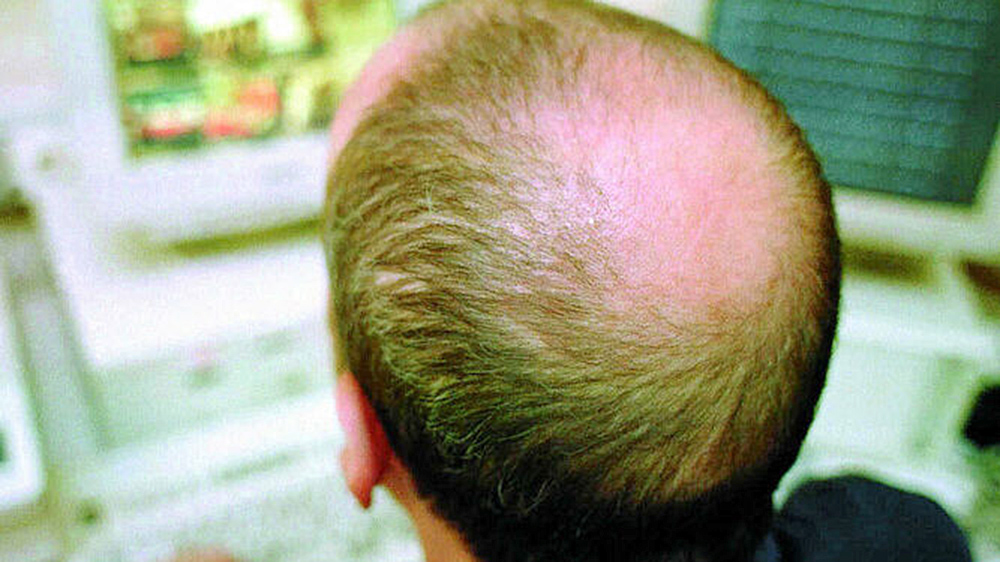 La calvicie, un trastorno genético sin cura