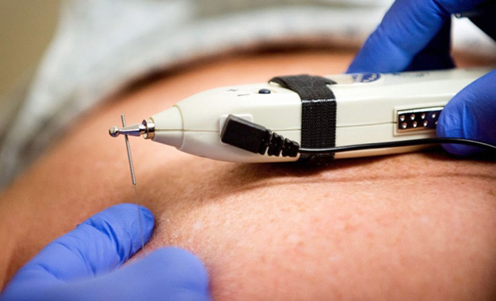 Los neuromoduladores, el futuro para controlar el Párkinson