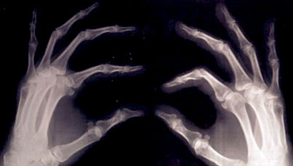 Ser mujer, principal factor de riesgo para contraer osteoporosis