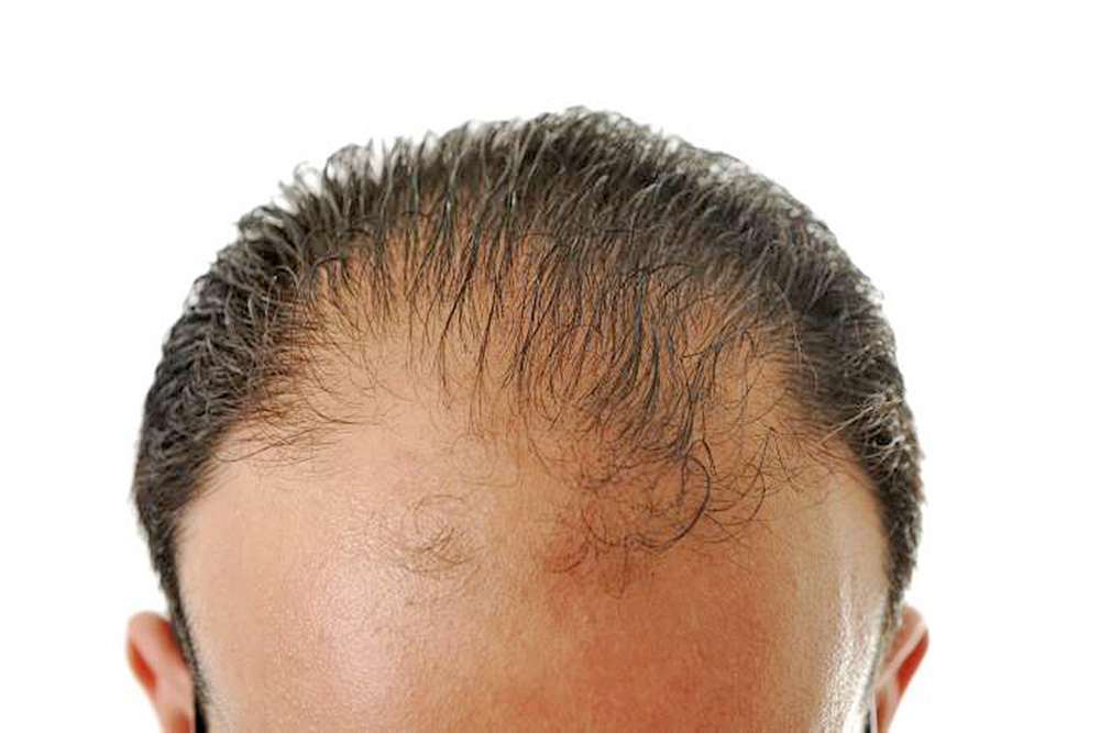 Biomagnetismo, una esperanza contra la calvicie