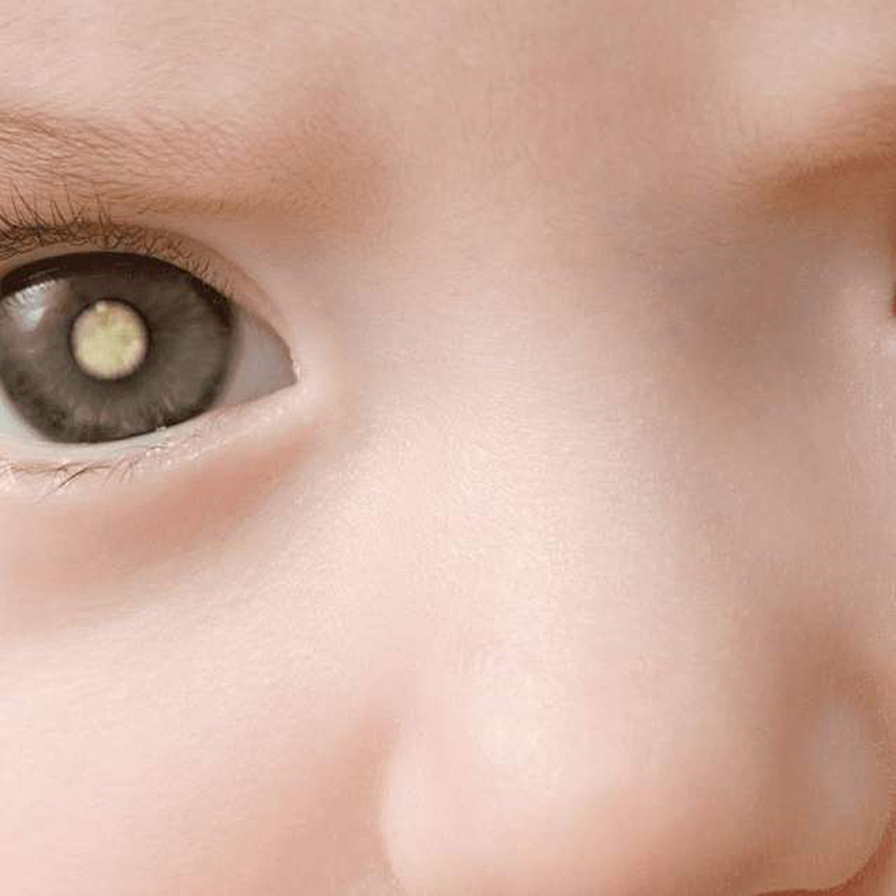 En el mundo, ocho mil casos anuales de cáncer de ojo en niños pequeños