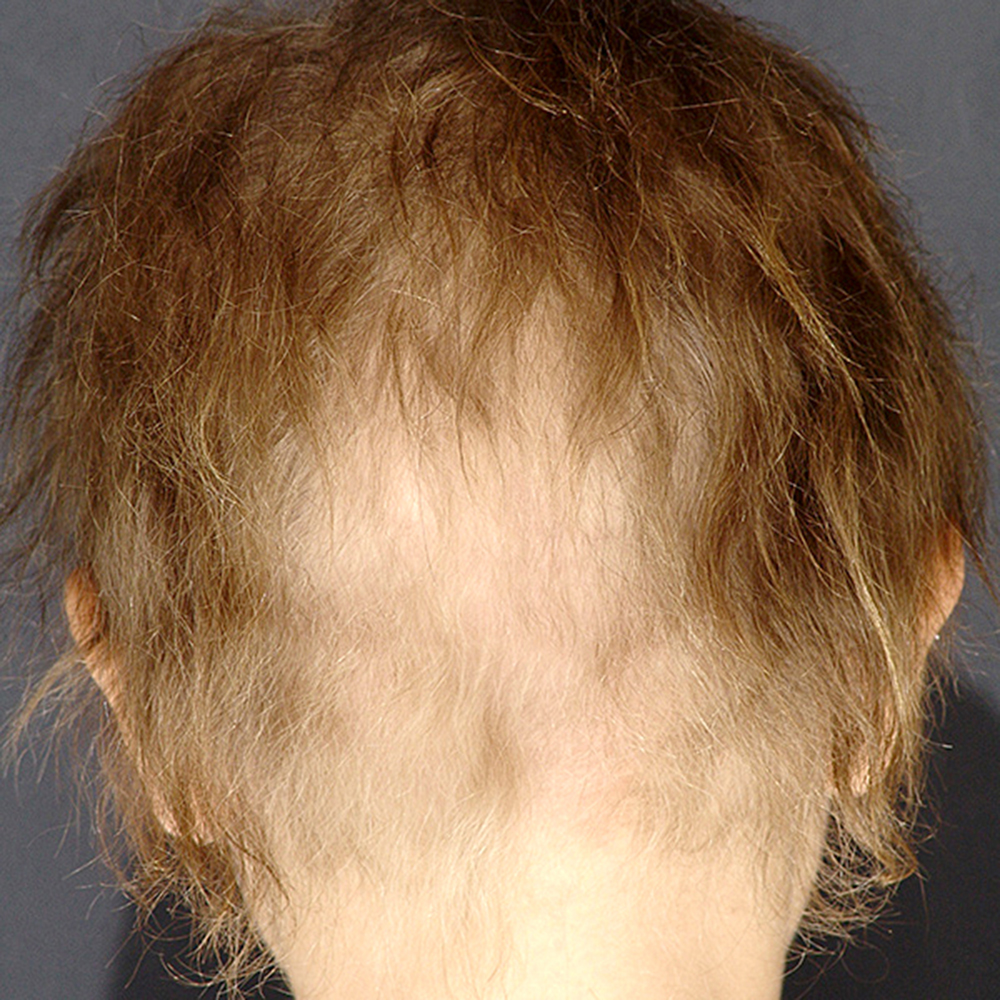 ¿Qué son las displasias ectodérmicas?