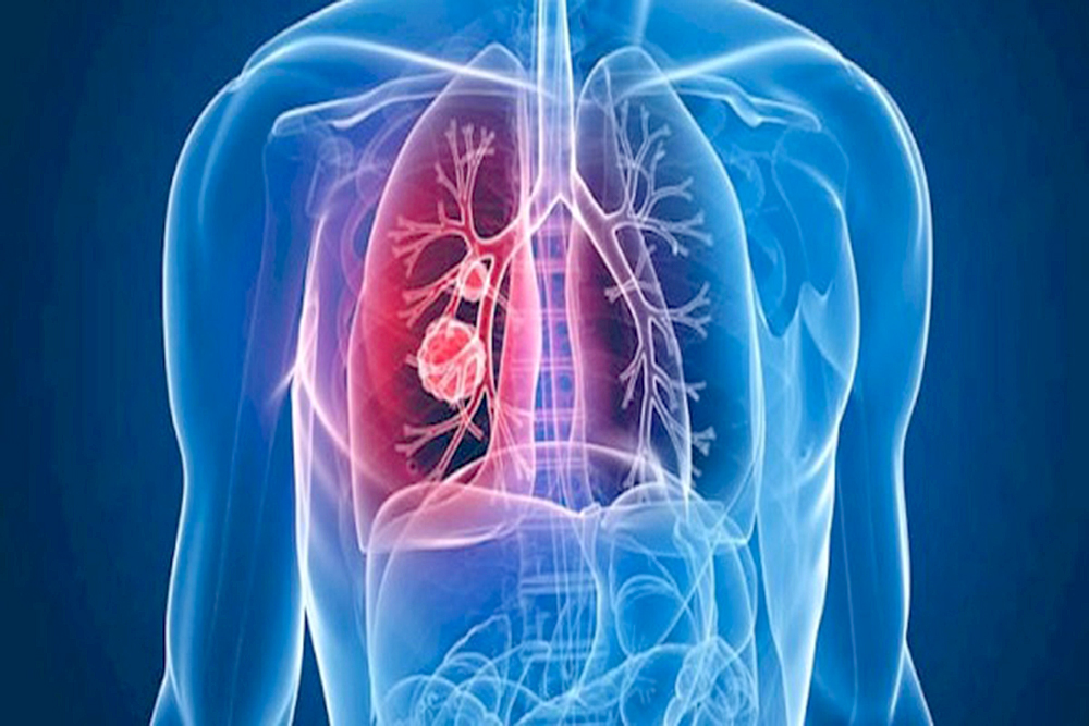 Proteína ósea coadyuva al tratamiento de hipertensión arterial pulmonar