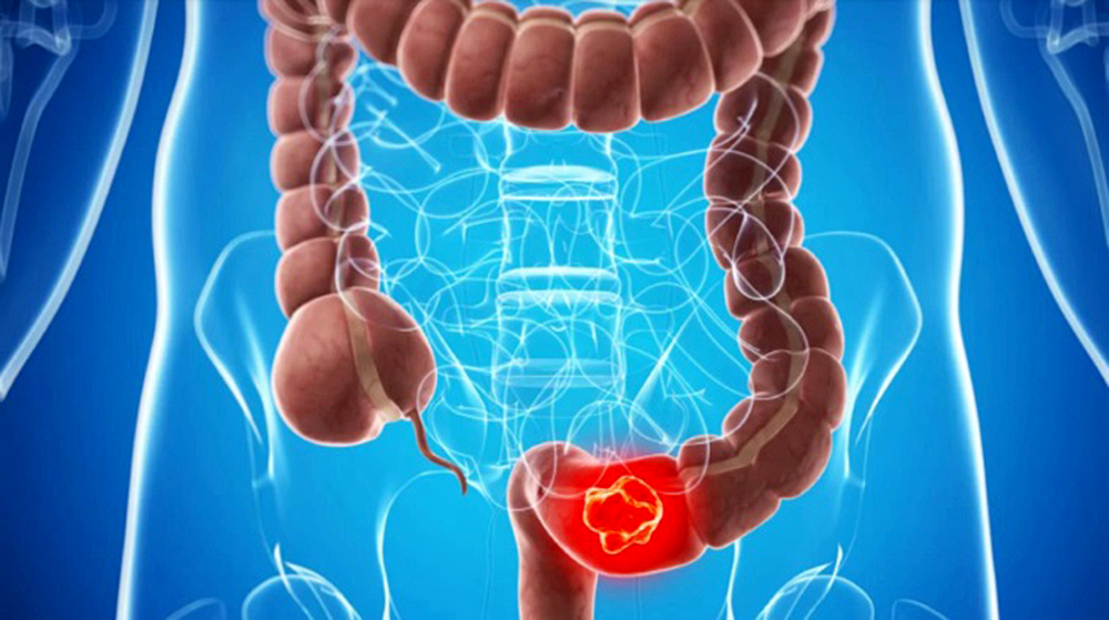 Especialistas identifican proteína que fomenta cánceres colorrectales
