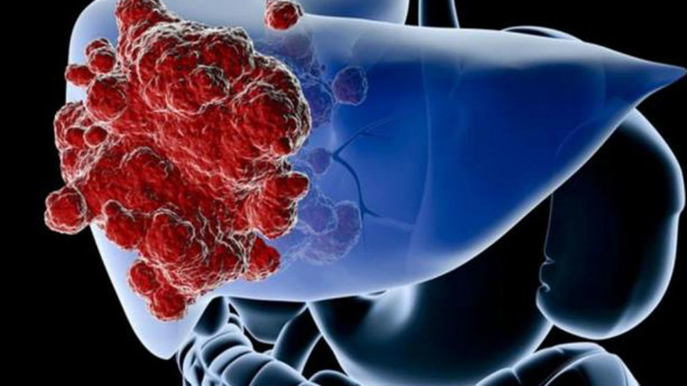 Cáncer de hígado, el tercero más mortífero