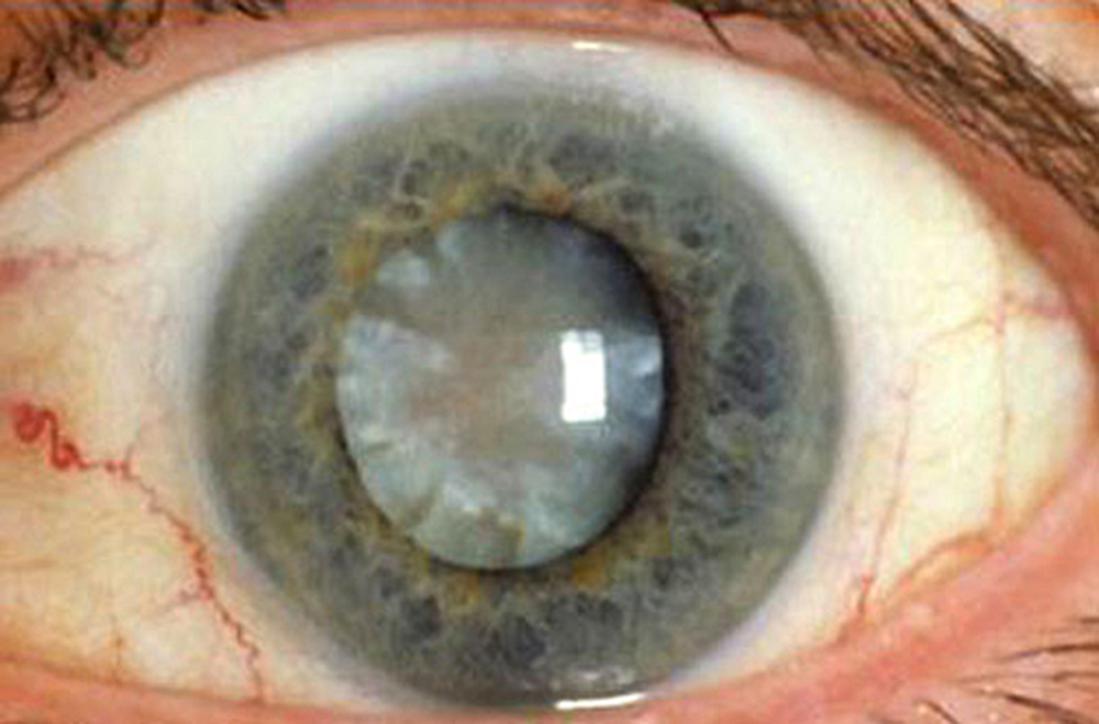 Cambios moleculares en el cristalino del ojo, señales de cataratas