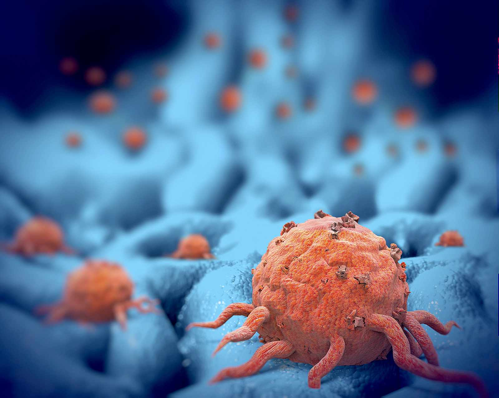 Progreso en desarrollo de análisis de orina certero, no invasivo, para cáncer de próstata