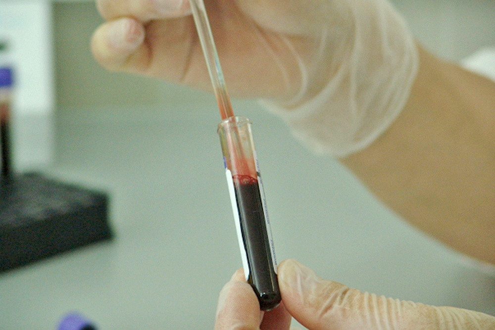 Leucemia, el cáncer indolente, qué es y cómo detectarlo