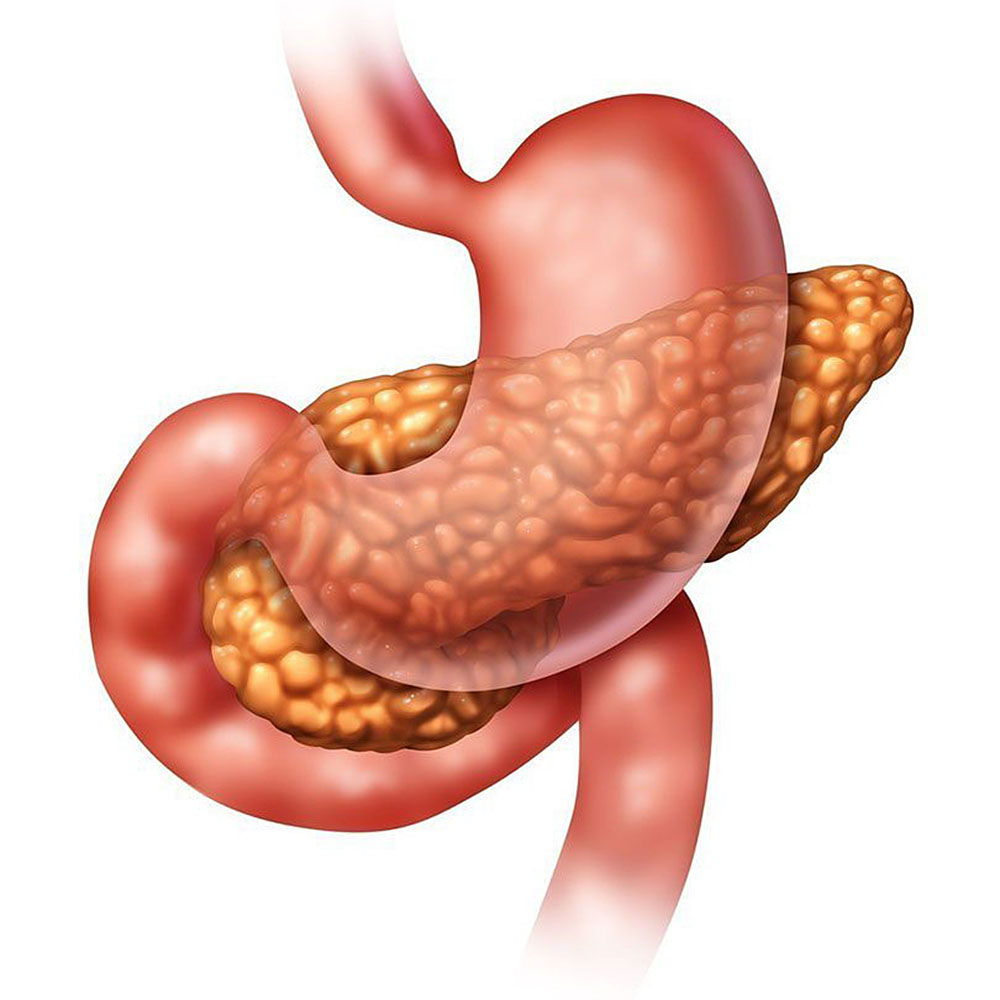 ¿Qué provoca la pancreatitis aguda?