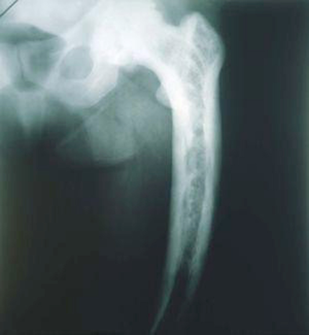 ¿Qué es la enfermedad de Paget y cuáles son sus síntomas?