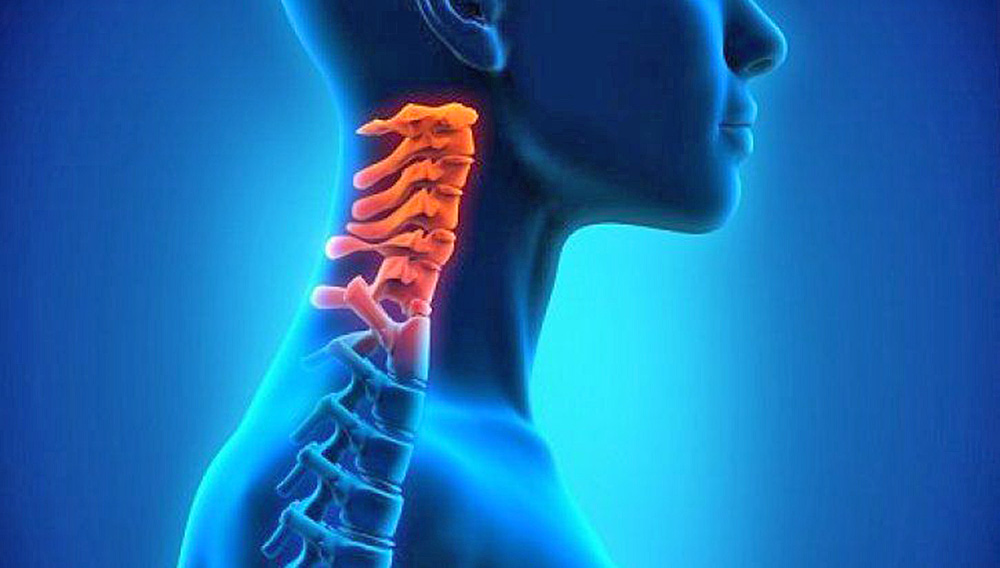¿Qué es la espondilosis cervical y cómo afecta al cuerpo?