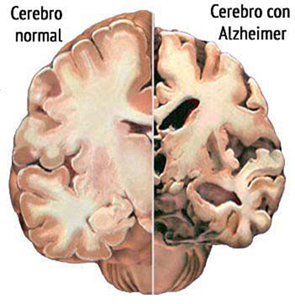 Desarrollan proteína para tratamiento de Alzheimer