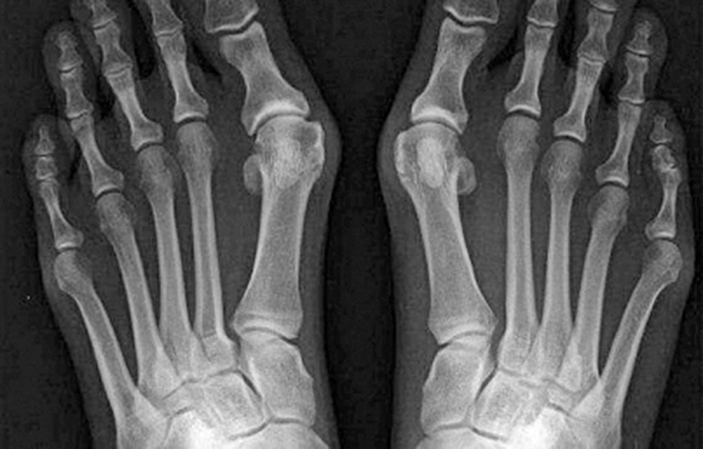 Artropatía de Charcot, lesión neuroartropática que afecta a diabéticos