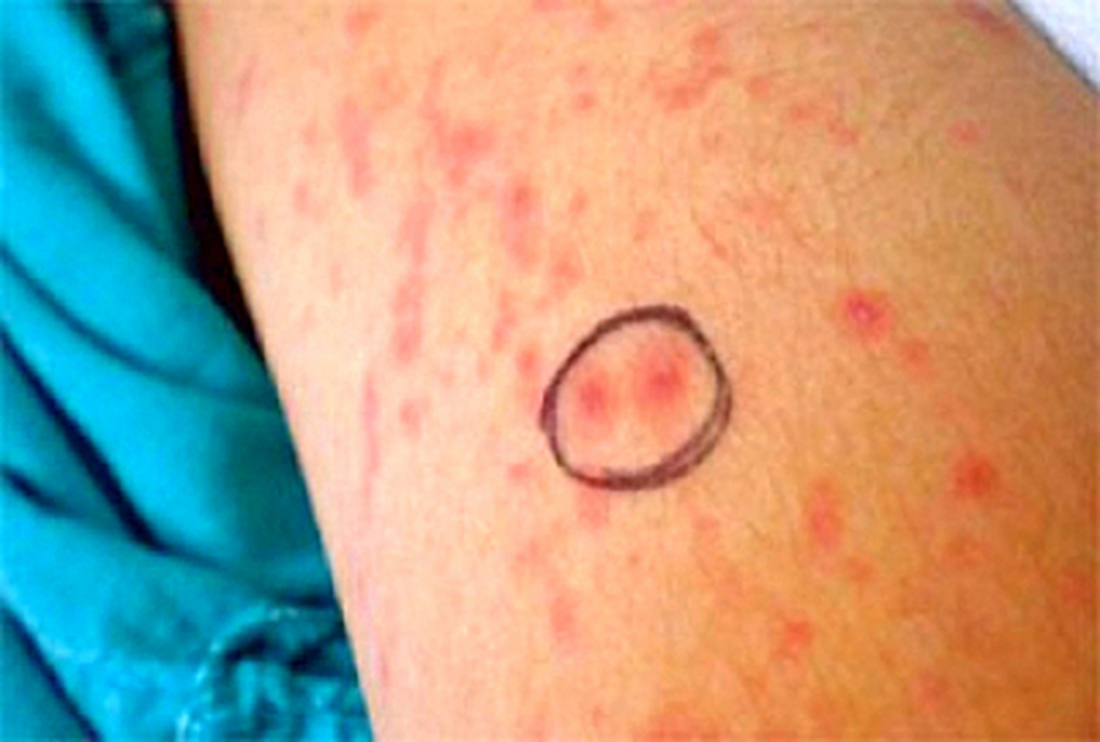 ¿Cómo es la dermatitis exfoliativa?