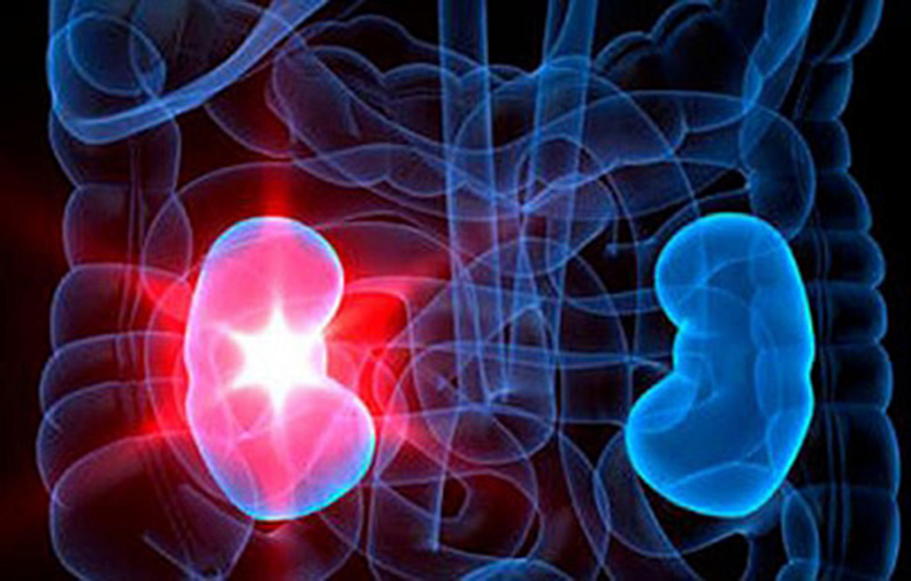 ¿Qué es la pielonefritis y cuáles son los síntomas?