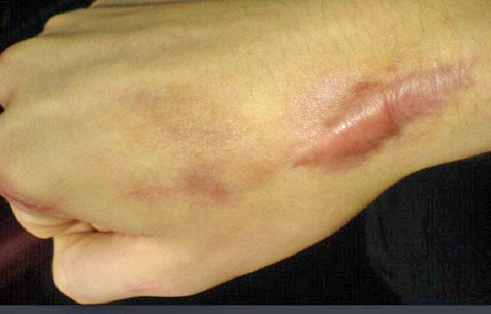 ¿Qué son los queloides?