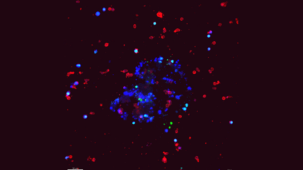 Células del cáncer de mama reprogramarían células inmunitarias para coadyuvar a la metástasis