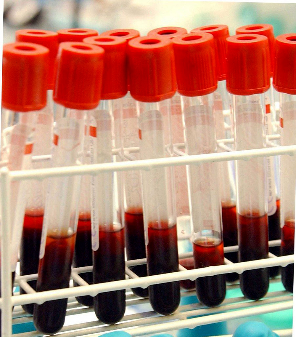 ¿Qué es la hemocromatosis?