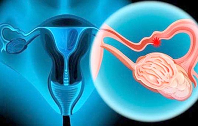 Crean Tratamiento De Cáncer De Ovario Que No Afecta Tejidos Sanos El Periódico Usa En