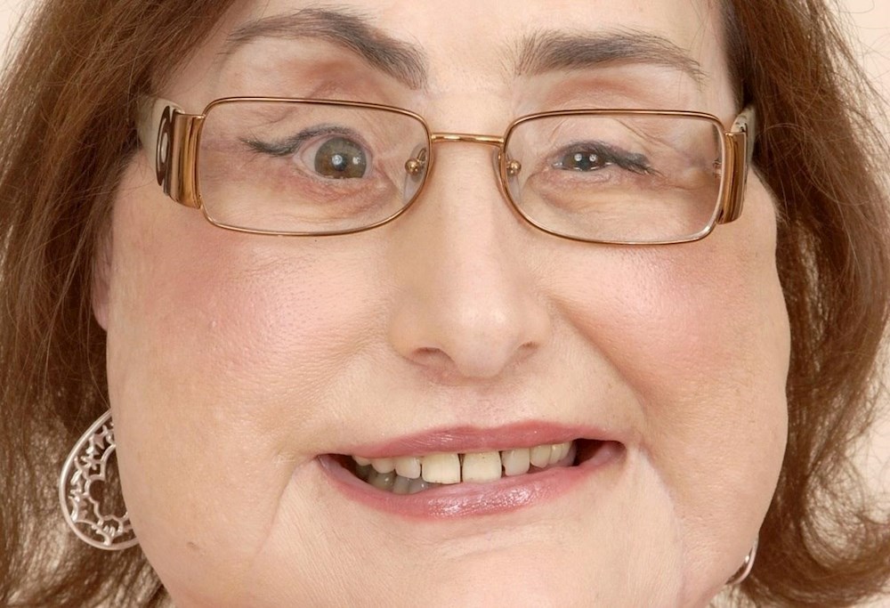 Muere la mujer que recibió el primer trasplante facial en E. U.
