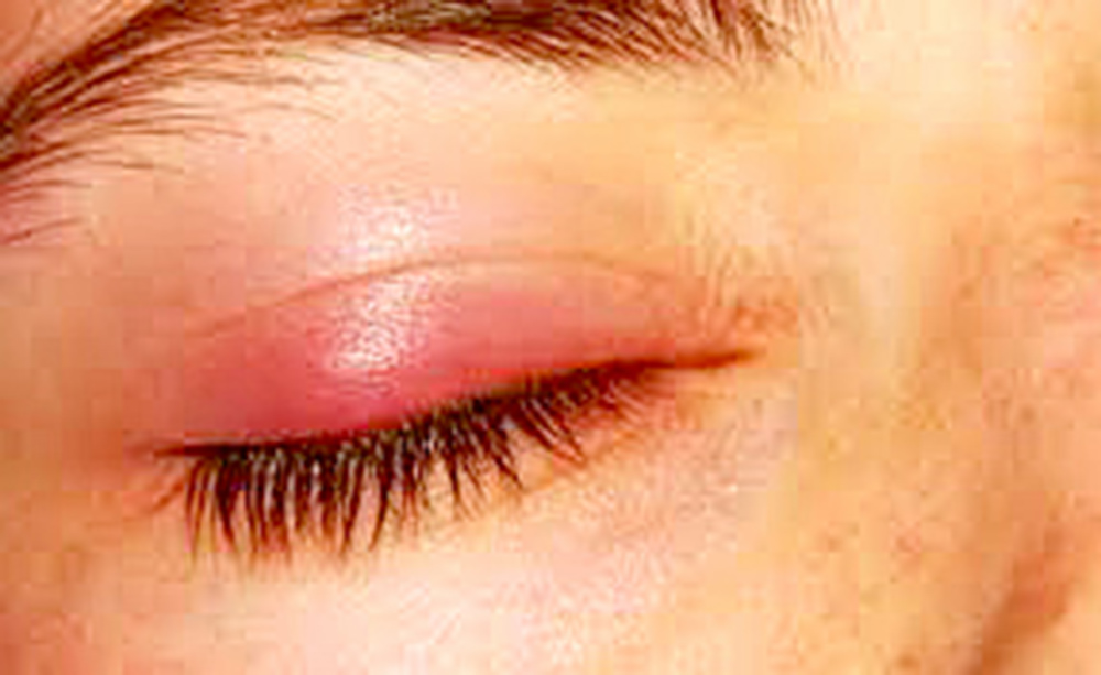 ¿Qué es la blefaritis?