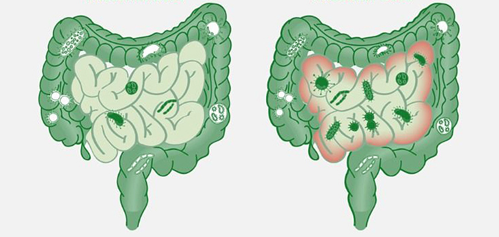 ¿Qué es el síndrome de proliferación bacteriana?