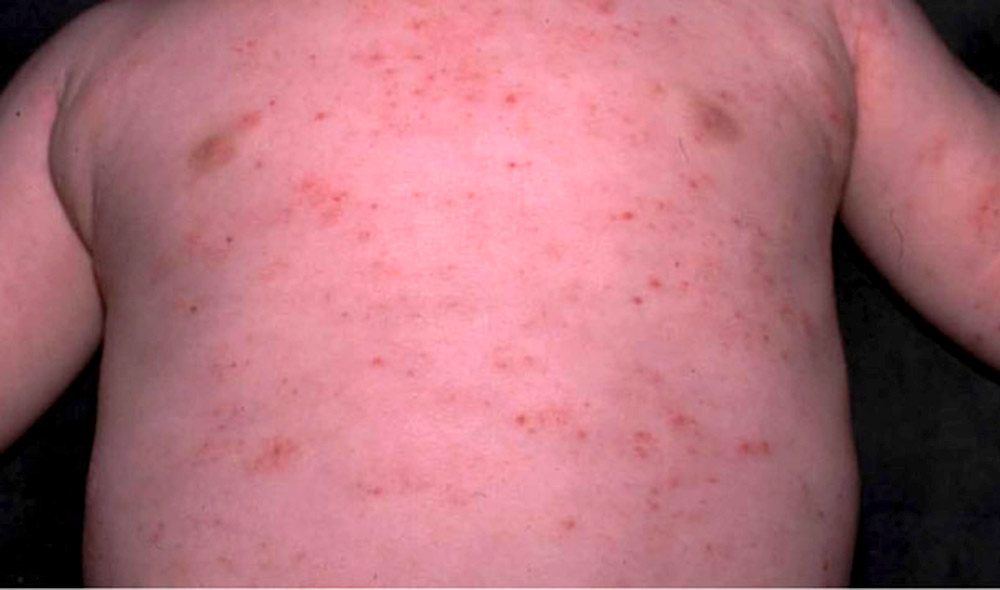 Esto es lo que debes saber acerca del síndrome de Wiskott-Aldrich