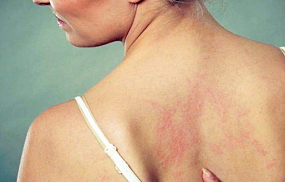 El 50% de las personas con enfermedades en la piel sufre depresión