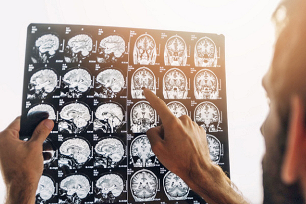 Científicos de la Universidad de Florida buscan tratar el Parkinson con fototerapia