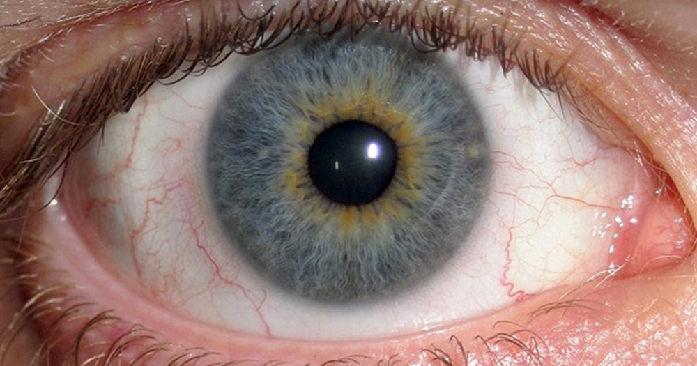 ¿Qué es la uveítis?