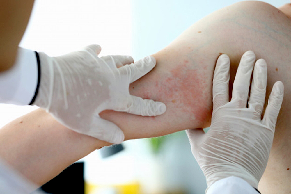 Estiman que en 2050 el 50% de la población padecerá de alguna alergia