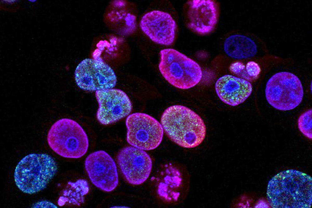 Desarrollan radioterapia de precisión para células cancerígenas en el hígado