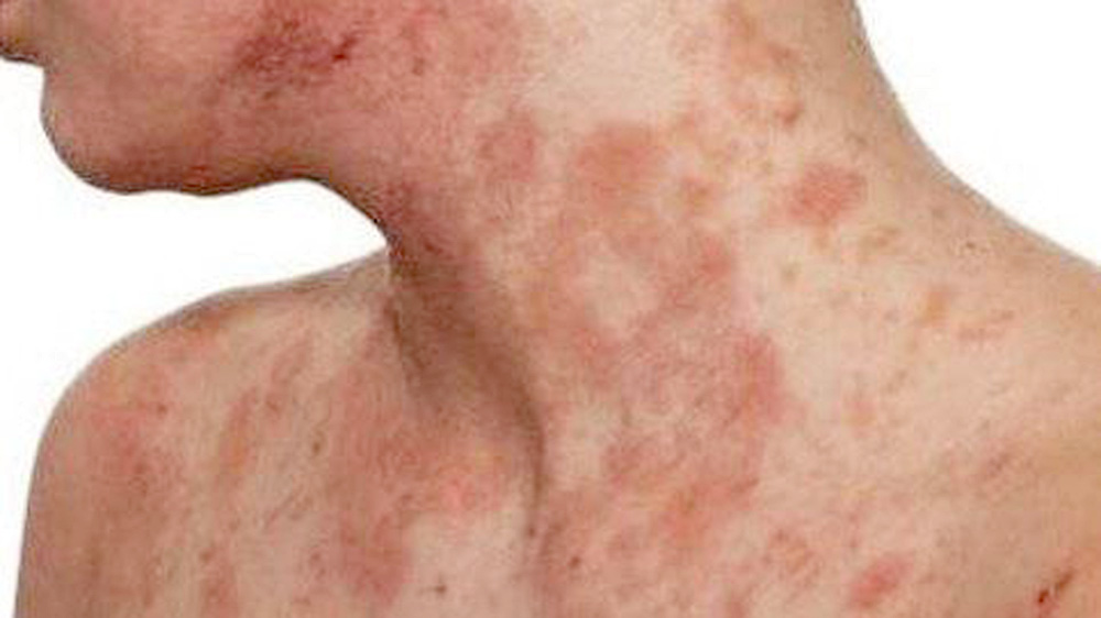 Dermatitis atópica afecta la vida laboral de los adultos que la padecen