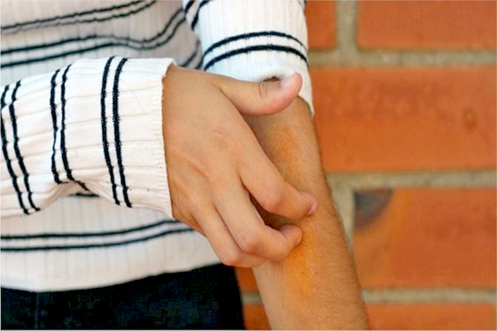 Científicos estudian relación de manifestaciones dermatológicas con la Covid-19