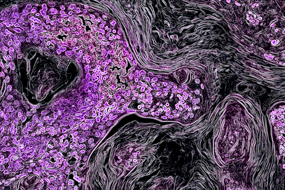 ¿Cuáles son los avances de biología molecular para cáncer de pulmón y próstata?