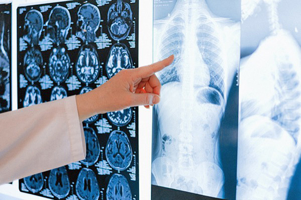 Origen de problemas neurológicos por Covid-19 podría estar en los vasos sanguíneos