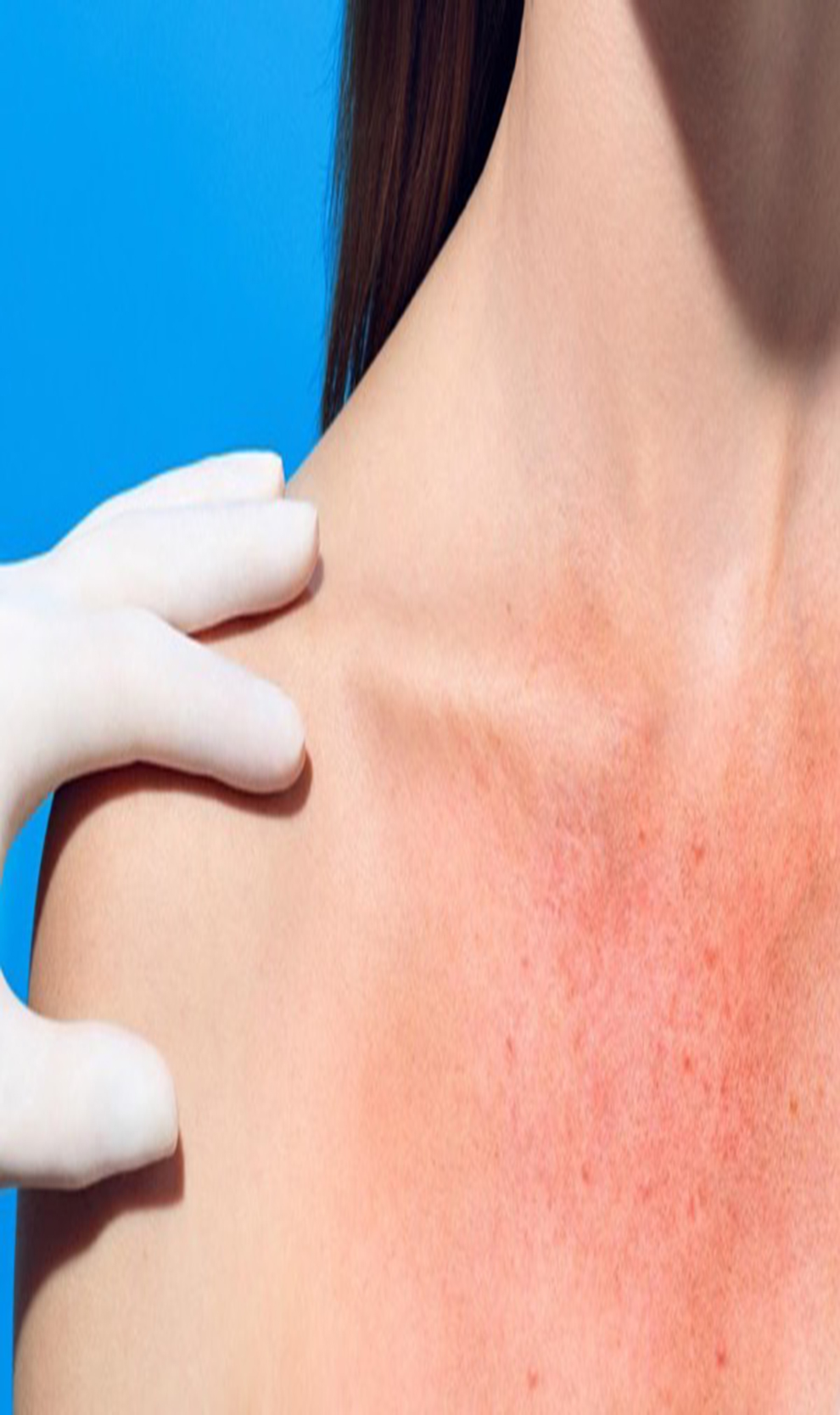 Protección solar, un asunto de salud pública, señalan expertos