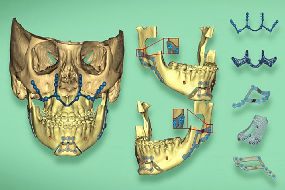 Reconstrucción mandibular en 3D mejora el procedimiento y la recuperación