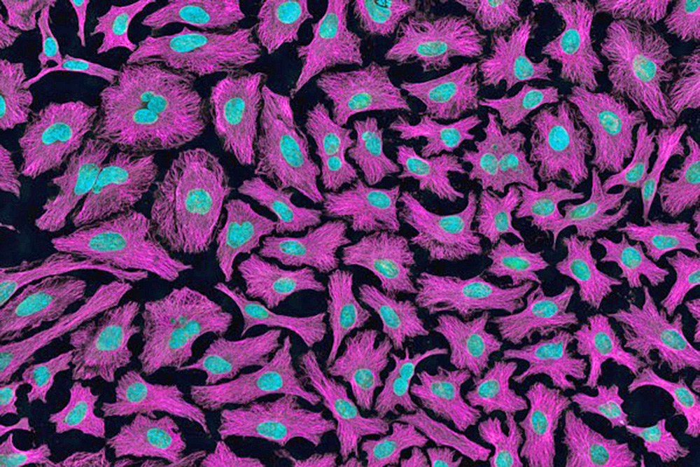 Los casos en que el cáncer puede ser hereditario