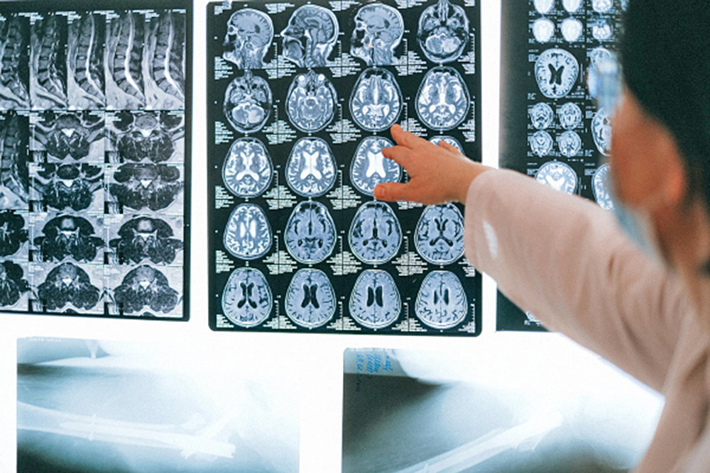 Investigadores descubren algoritmo para estimar el tiempo de aparición del Alzheimer