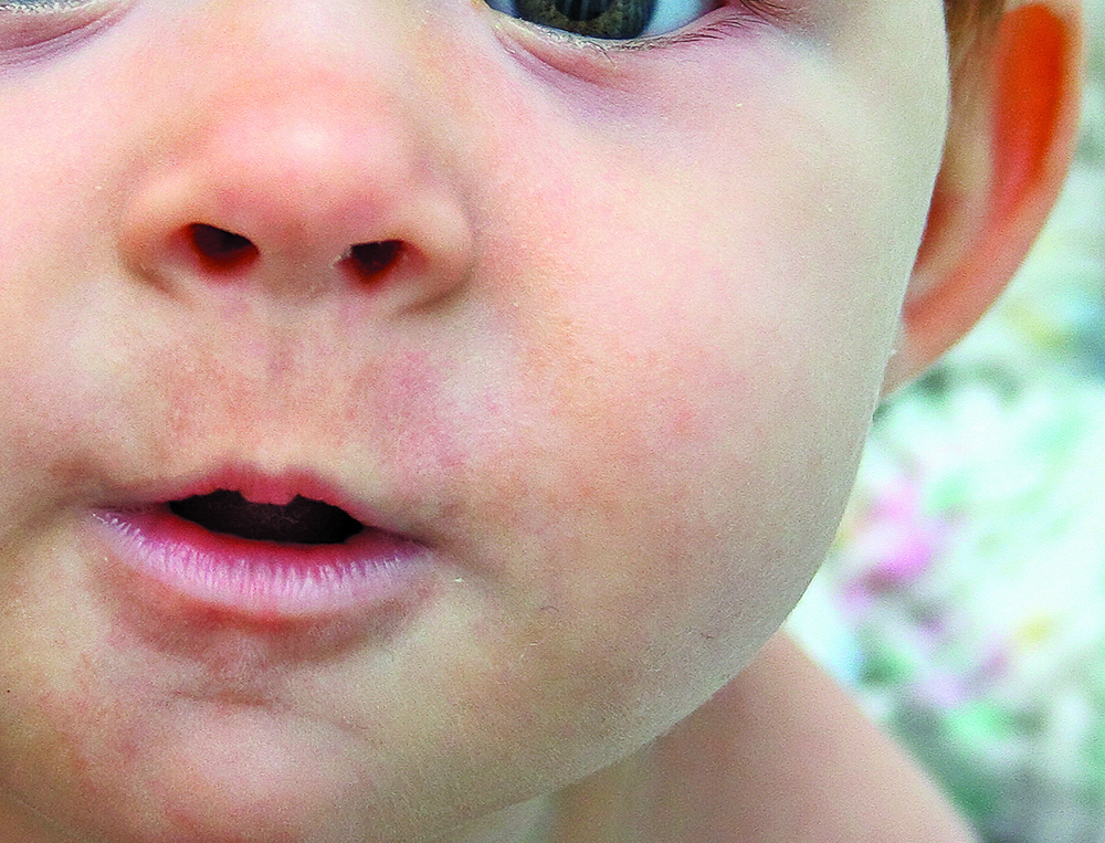 Cómo prevenir los resfriados de niños y bebés con una limpieza nasal