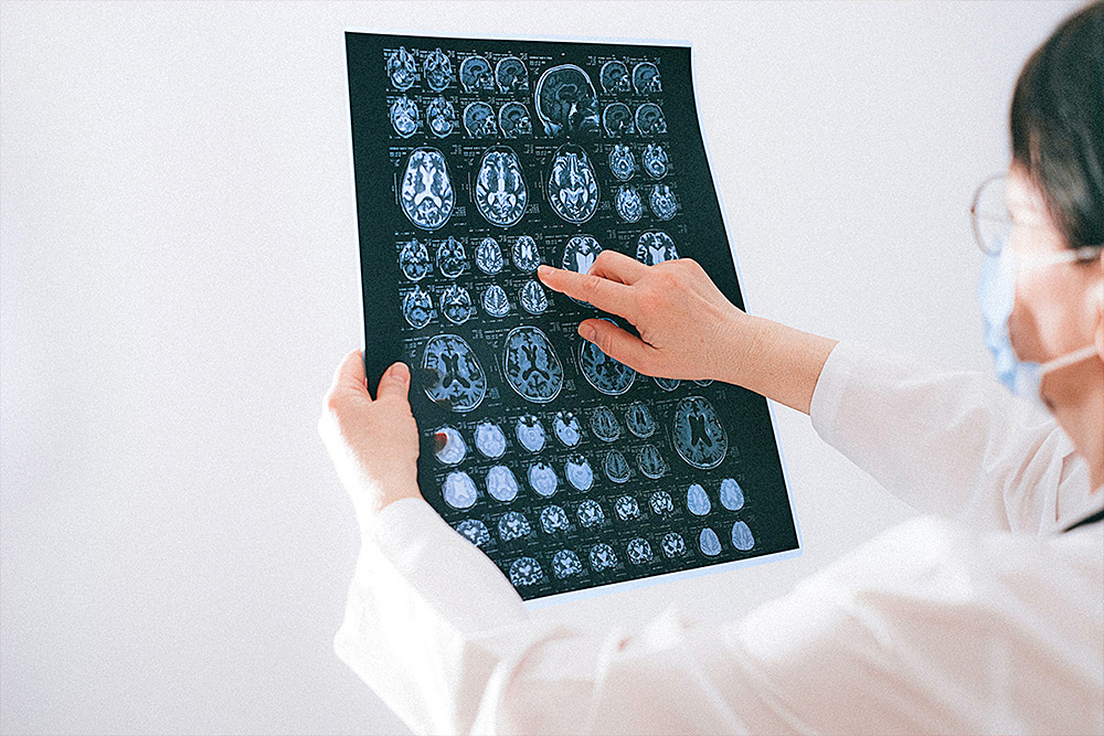 Cómo detectar enfermedades cerebrovasculares, segunda causa de muerte a nivel mundial